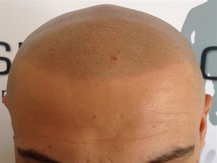 hide_hairloss